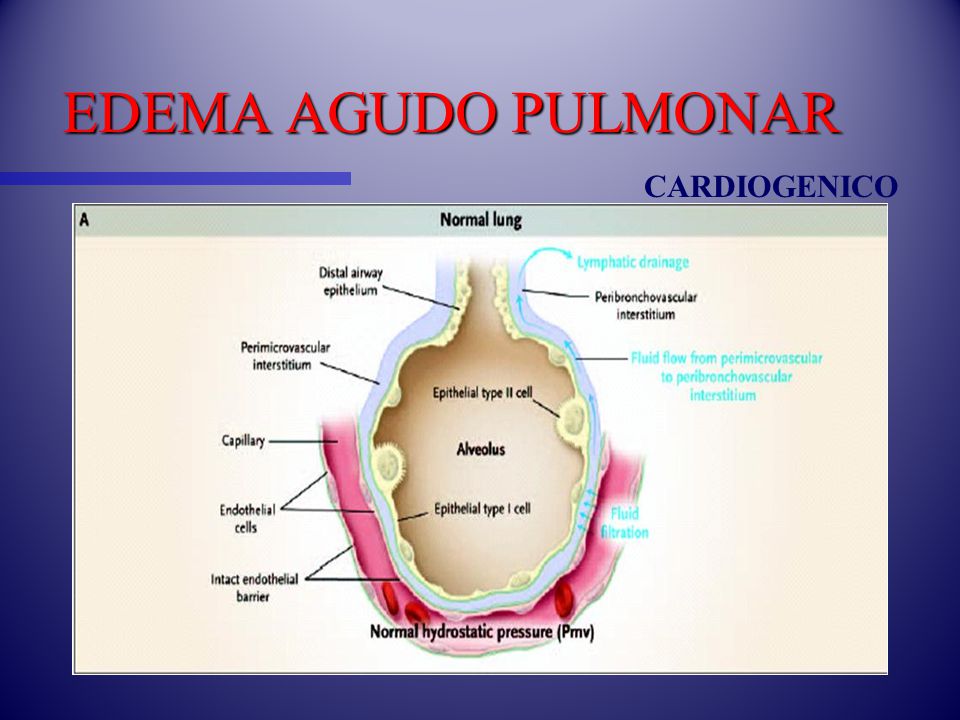 edema agudo pulmonar cardiogenico